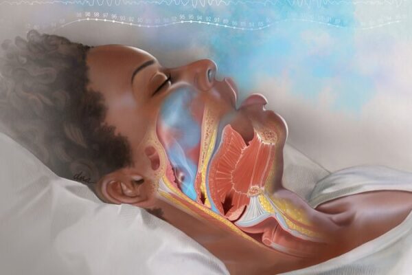 Australian Study Unveils Link Between Snoring and High Blood Pressure Australian Study Unveils Link Between Snoring and High Blood Pressure
