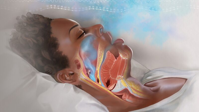 Australian_Study_Unveils_Link_Between_Snoring_and_High_Blood_Pressure - Khabar Asia Australian Study Unveils Link Between Snoring and High Blood Pressure