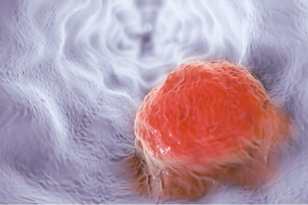 Chinese AI Platform Doubles Early Detection Rates of Esophageal Cancer Chinese AI Platform Doubles Early Detection Rates of Esophageal Cancer