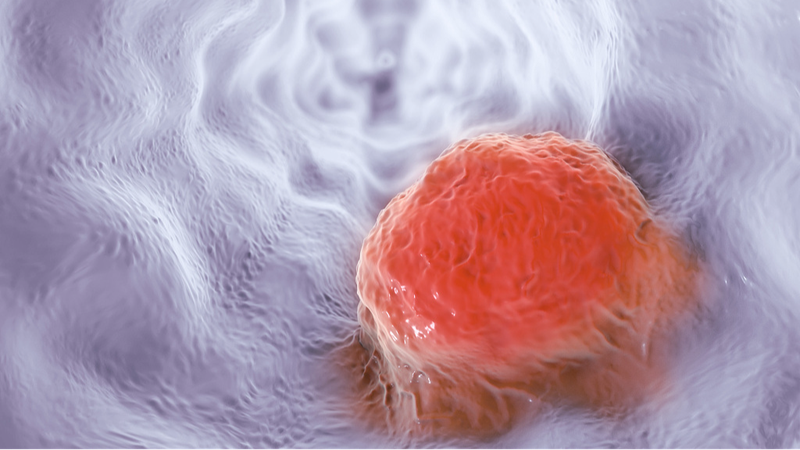 Chinese AI Platform Doubles Early Detection Rates of Esophageal Cancer