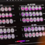 Study Identifies APOE4 Gene as Genetic Form of Alzheimer's Disease