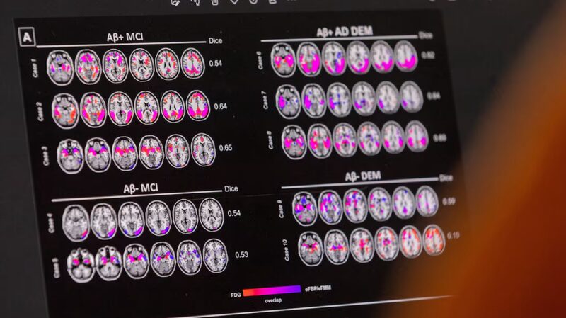 Study_Identifies_APOE4_Gene_as_Genetic_Form_of_Alzheimers_Disease - Khabar Asia Study Identifies APOE4 Gene as Genetic Form of Alzheimer's Disease
