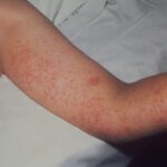 Texas_Measles_Outbreak_Crosses_Borders_as_Vaccination_Rates_Lag video poster