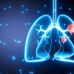 Air_Pollution_Tied_to_Lung_Cancer_Mutations_in_Nonsmokers__Study - Khabar Asia Air_Pollution_Tied_to_Lung_Cancer_Mutations_in_Nonsmokers__Study