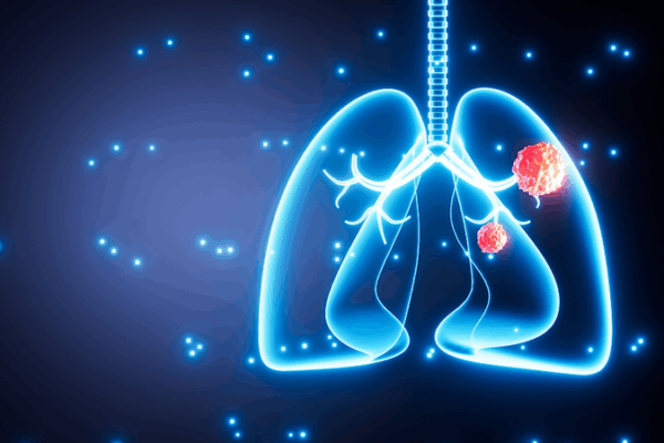 Air Pollution Tied to Lung Cancer Mutations in Nonsmokers: Study Air_Pollution_Tied_to_Lung_Cancer_Mutations_in_Nonsmokers__Study