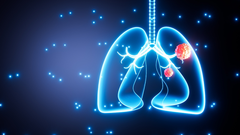 Air_Pollution_Tied_to_Lung_Cancer_Mutations_in_Nonsmokers__Study - Khabar Asia Air_Pollution_Tied_to_Lung_Cancer_Mutations_in_Nonsmokers__Study