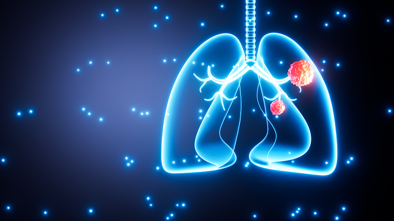1 in 5 Lung Cancer Patients Are Nonsmokers: Global Study Reveals Risks 1_in_5_Lung_Cancer_Patients_Are_Nonsmokers__Global_Study_Reveals_Risks