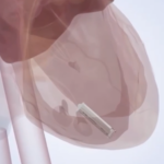 China_Unveils_Self_Powered_Micro_Pacemaker__Revolutionizing_Cardiac_Care - Khabar Asia China_Unveils_Self_Powered_Micro_Pacemaker__Revolutionizing_Cardiac_Care