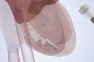 China_Unveils_Self_Powered_Micro_Pacemaker__Revolutionizing_Cardiac_Care