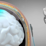 China_Pioneers_World_s_First_Invasive_BCI_Medical_Device_for_Commercial_Use - Khabar Asia China_Pioneers_World_s_First_Invasive_BCI_Medical_Device_for_Commercial_Use