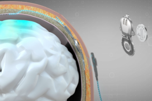 China_Pioneers_World_s_First_Invasive_BCI_Medical_Device_for_Commercial_Use